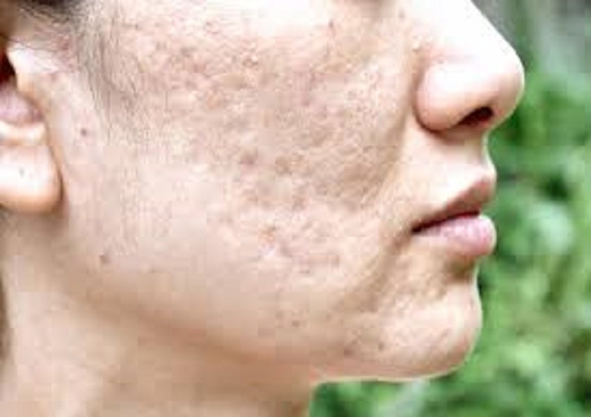 Acne Scar & Striae Treatment