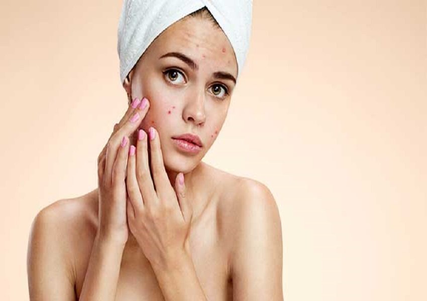 Acne Treatment / Pimple