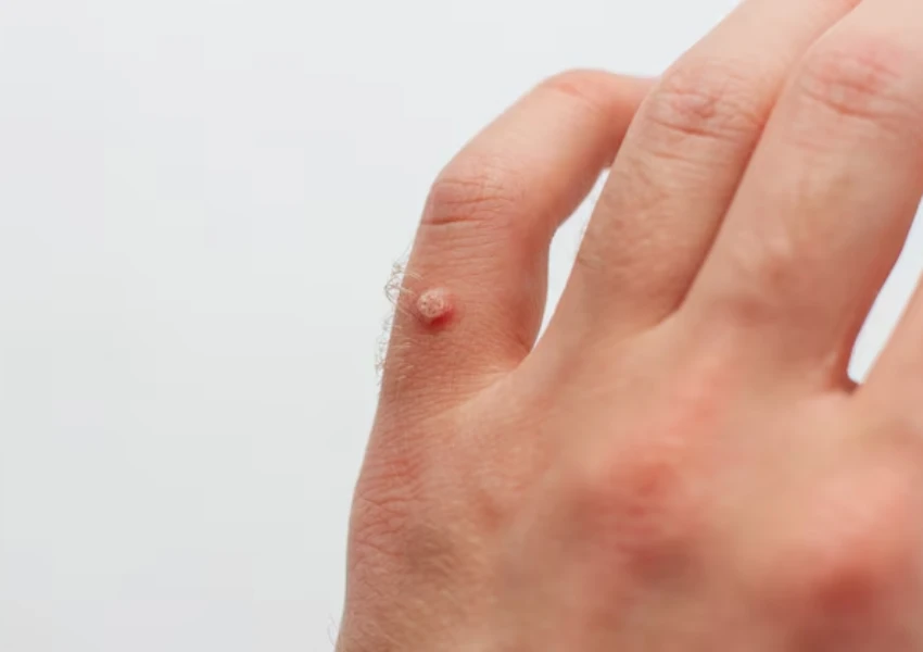 Most common warts go away without treatment