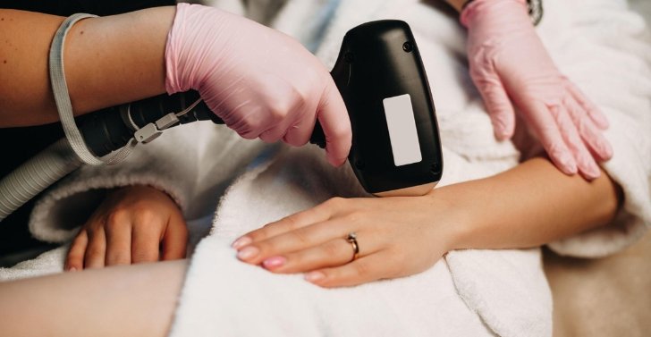 Laser Hair Removal Session