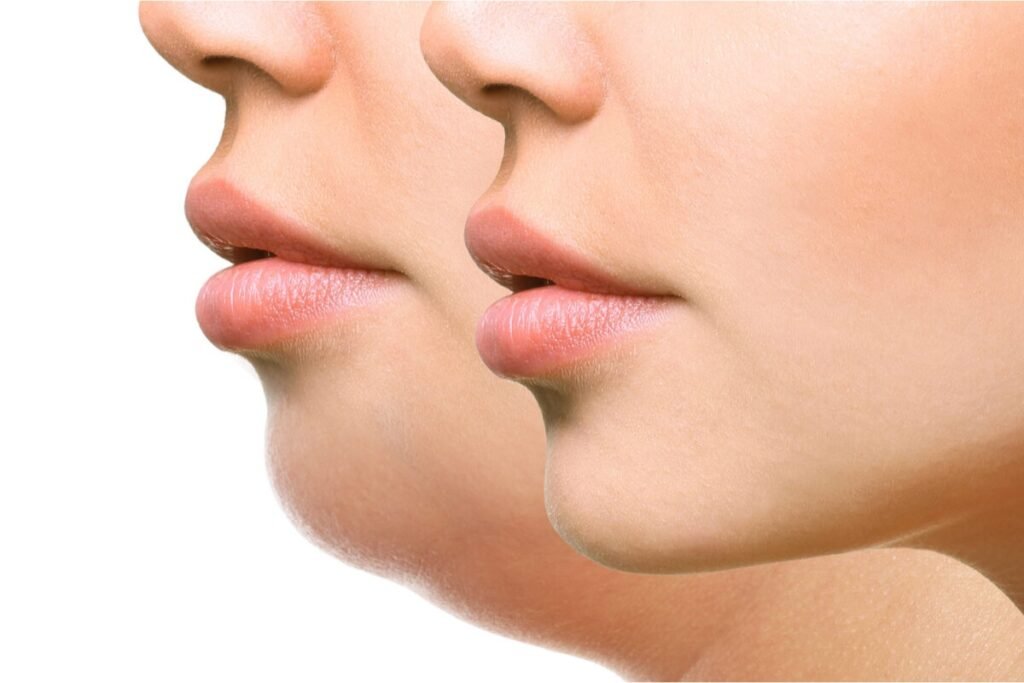 Double Chin Correction Surgery