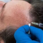 Benefits of Growth Factor Concentrate (GFC) Treatment