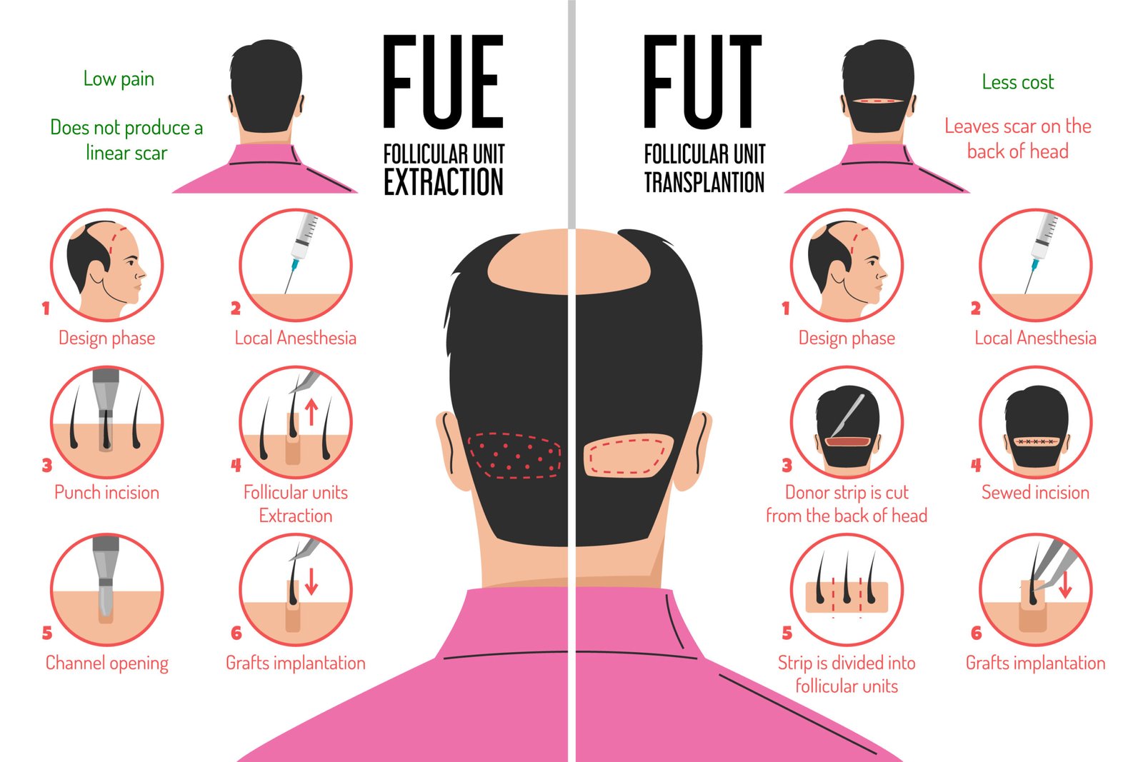 FUE FUT Hair transplant