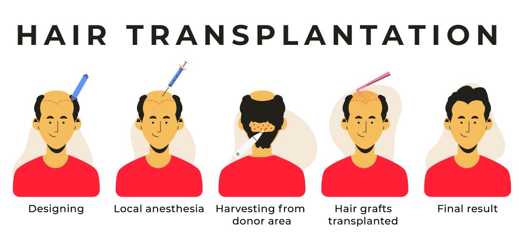 Hair Transplant Clinic in Bangalore