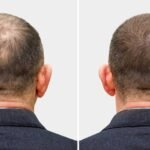Hair Transplant Myths Busted