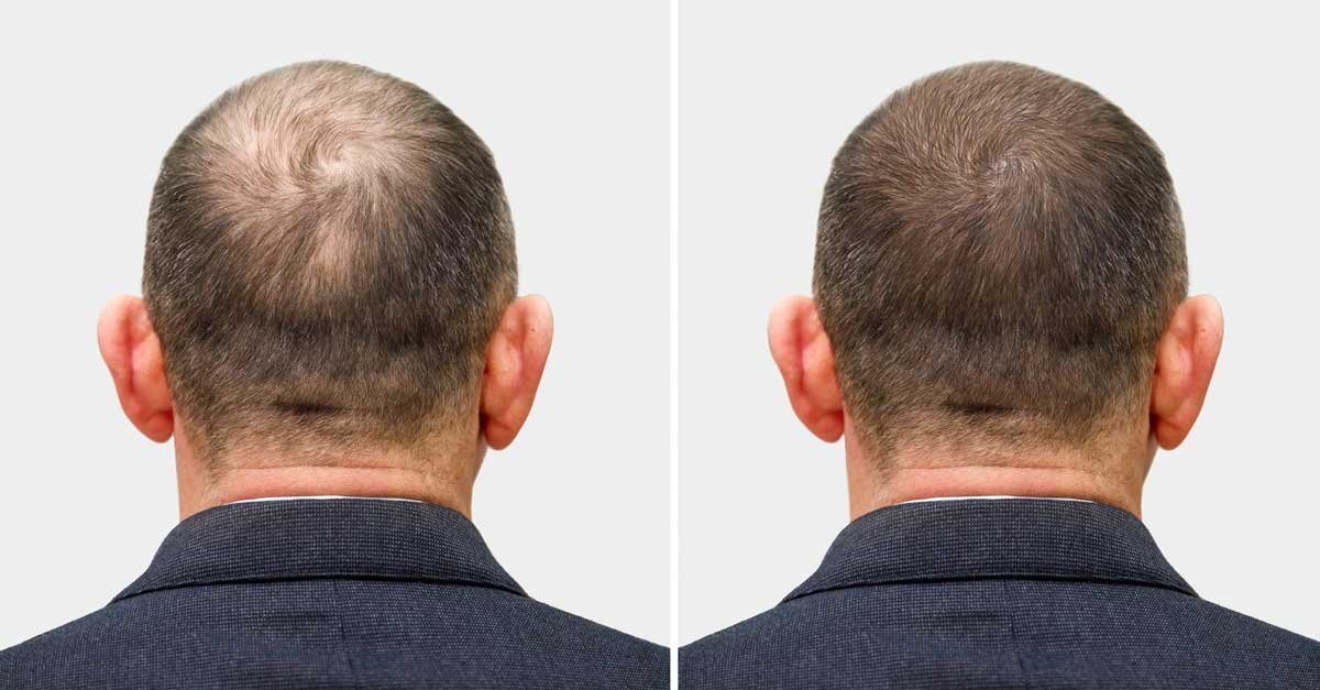 Hair Transplant Myths Busted