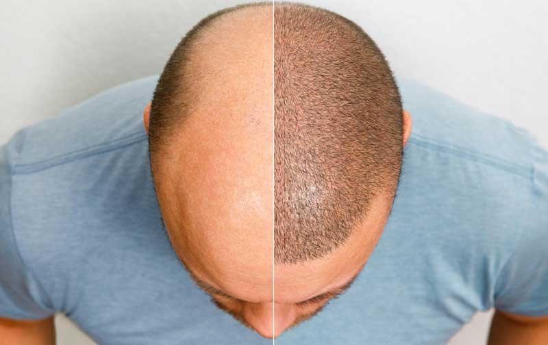 Hair Transplant Clinic in Bangalore