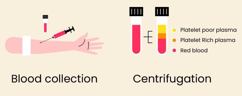 Platelet-Rich Plasma Separation