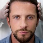 About Hair Transplants