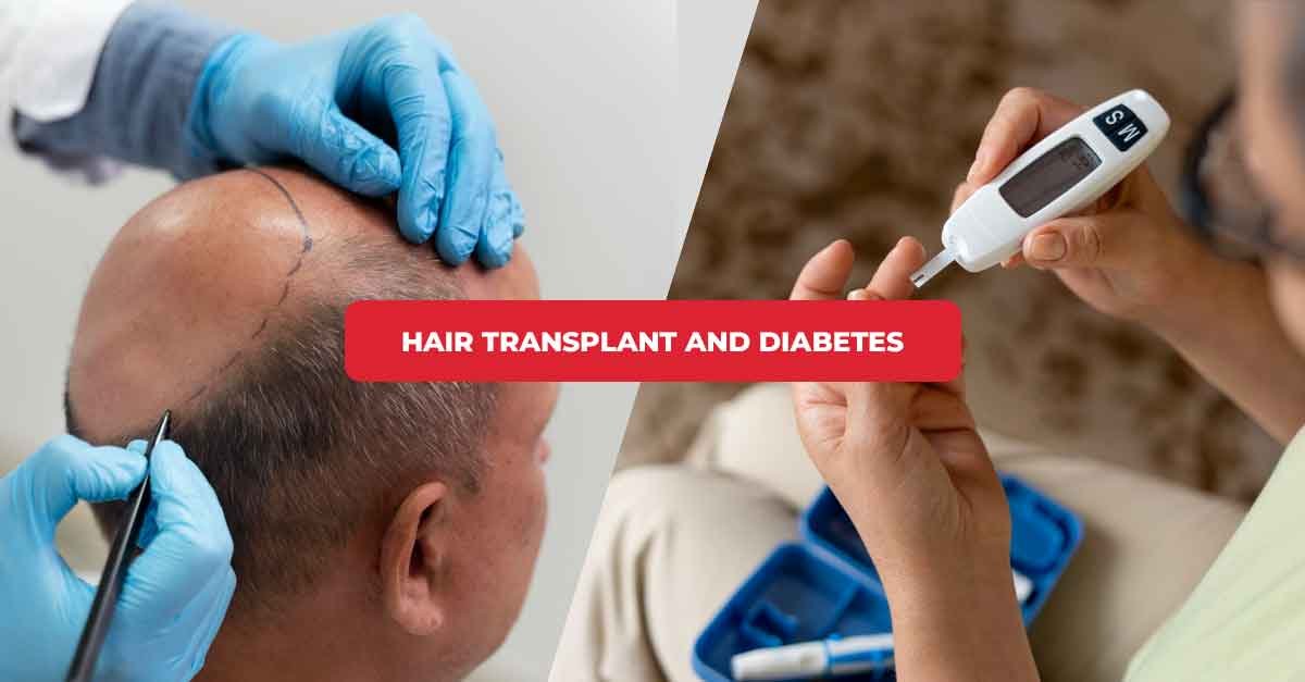Hair Transplant and Diabetes