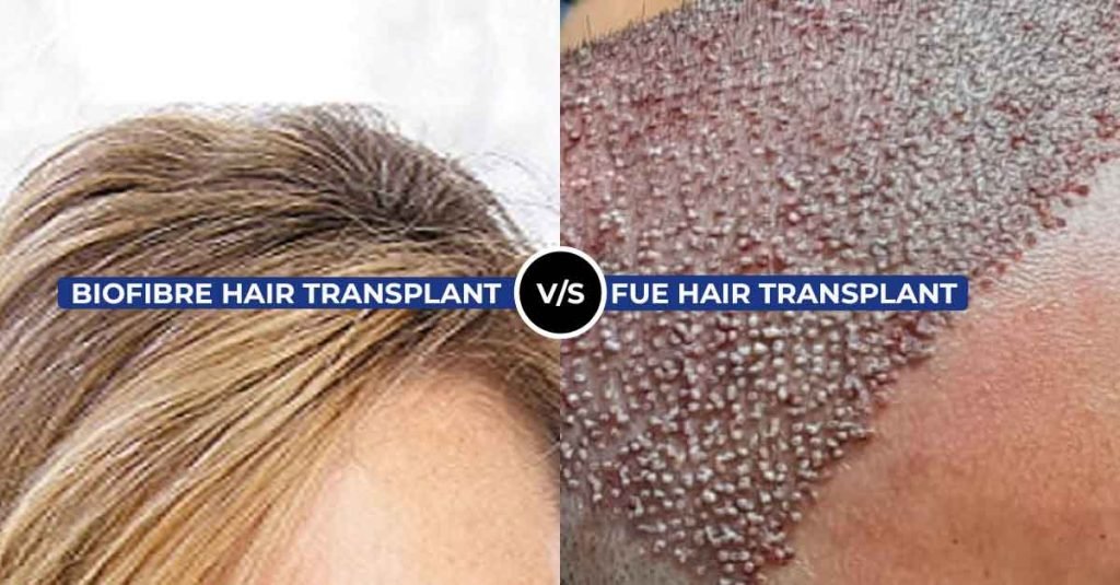 Biofibre and Bio FUE Hair Transplant