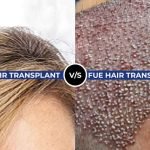 Biofibre and Bio FUE Hair Transplant