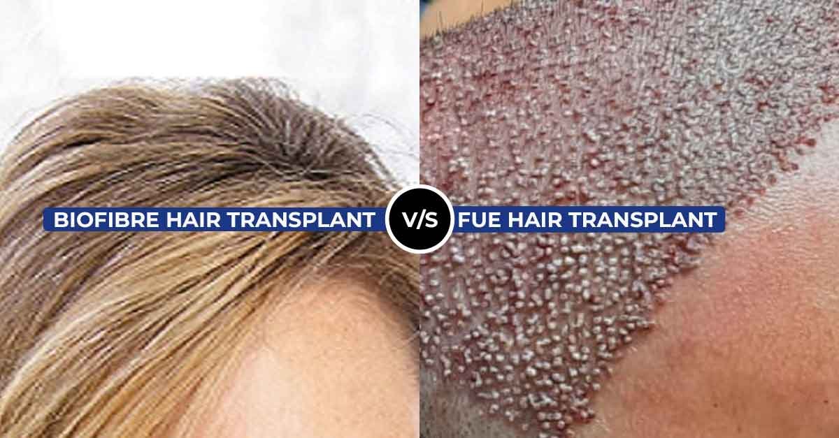 Biofibre and Bio FUE Hair Transplant