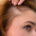 Hair Transplants for Women