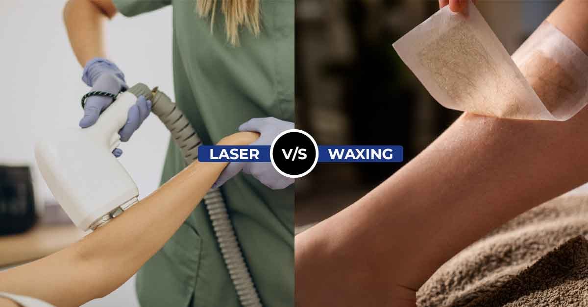 Laser vs. Waxing
