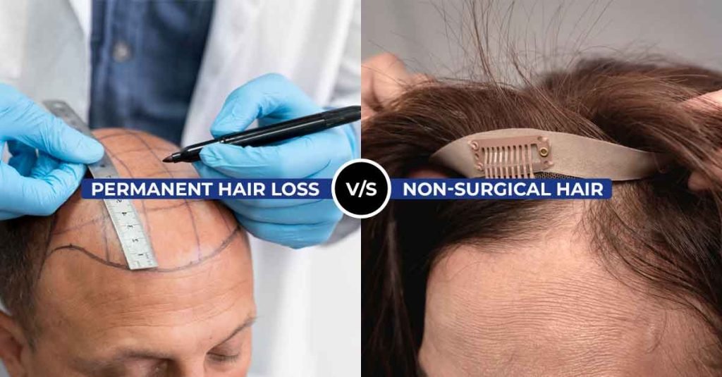 Permanent Hair Loss vs. Non-Surgical Hair