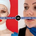 Vampire Facelift Vs Standard Facelift