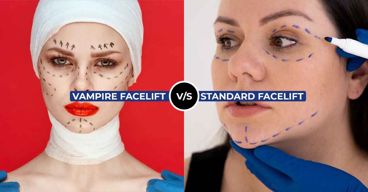Vampire Facelift Vs Standard Facelift