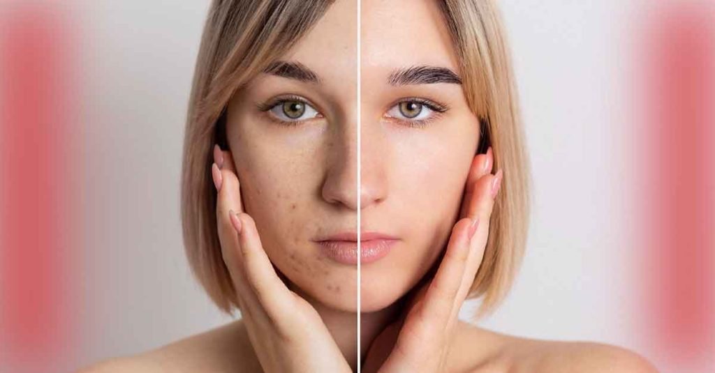 Acne Typesn causes treatment options