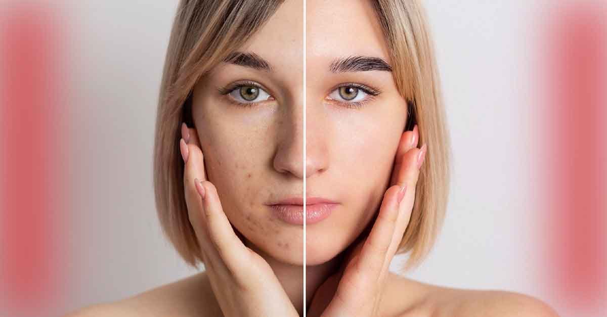 Acne Typesn causes treatment options