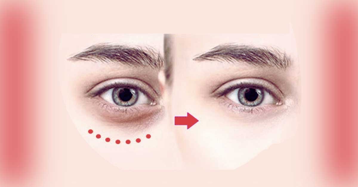 Dark Circles Under Your Eyes