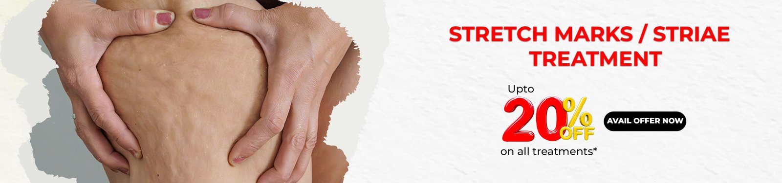 stretch marks removal treatment