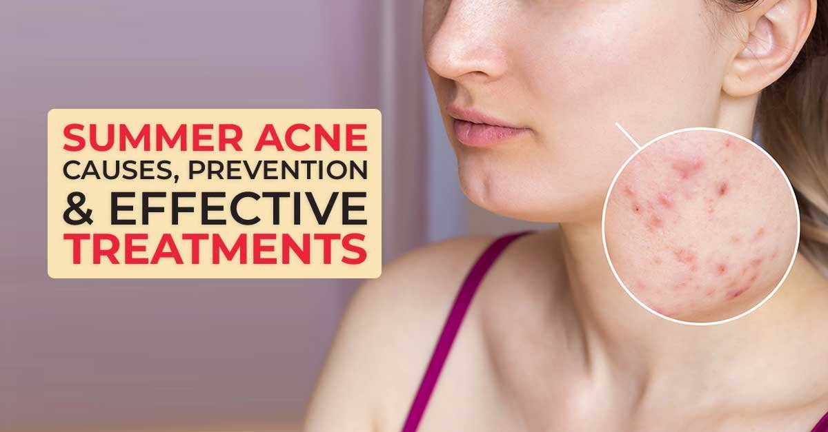 Summer Acne