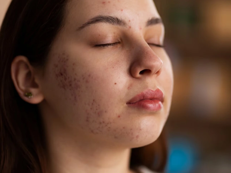 Pigmentation Treatment in Jayanagar