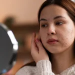 Hormonal Acne in Adults: Causes, Symptoms & Treatments