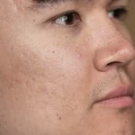 Acne Scar Treatments