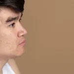 Acne vs Acne Scars: Understanding the Difference and Best Treatments