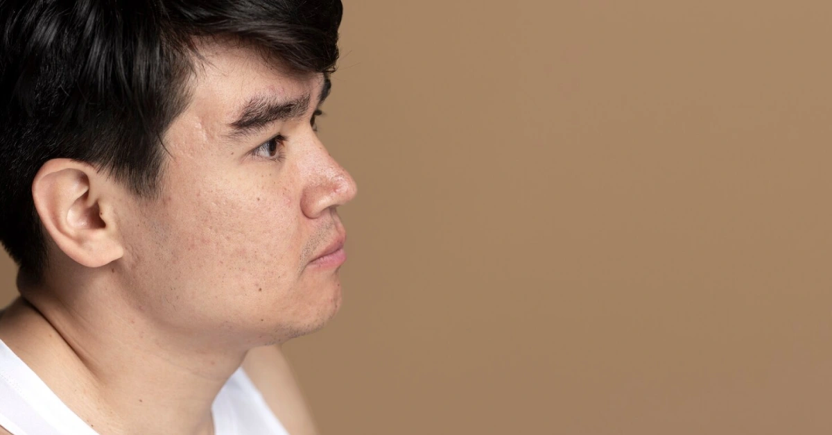 Acne vs Acne Scars: Understanding the Difference and Best Treatments