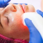 Laser Treatments Help Remove Pigmentation