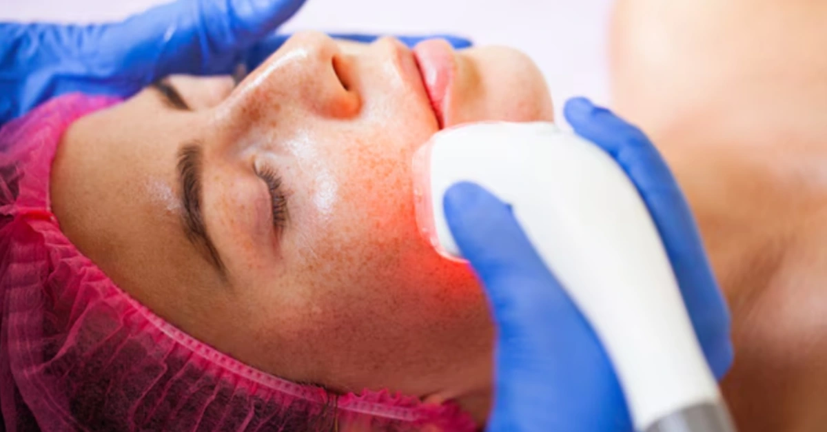 Laser Treatments Help Remove Pigmentation