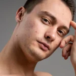 Top Dermatologist-Recommended Treatments for Acne Scars