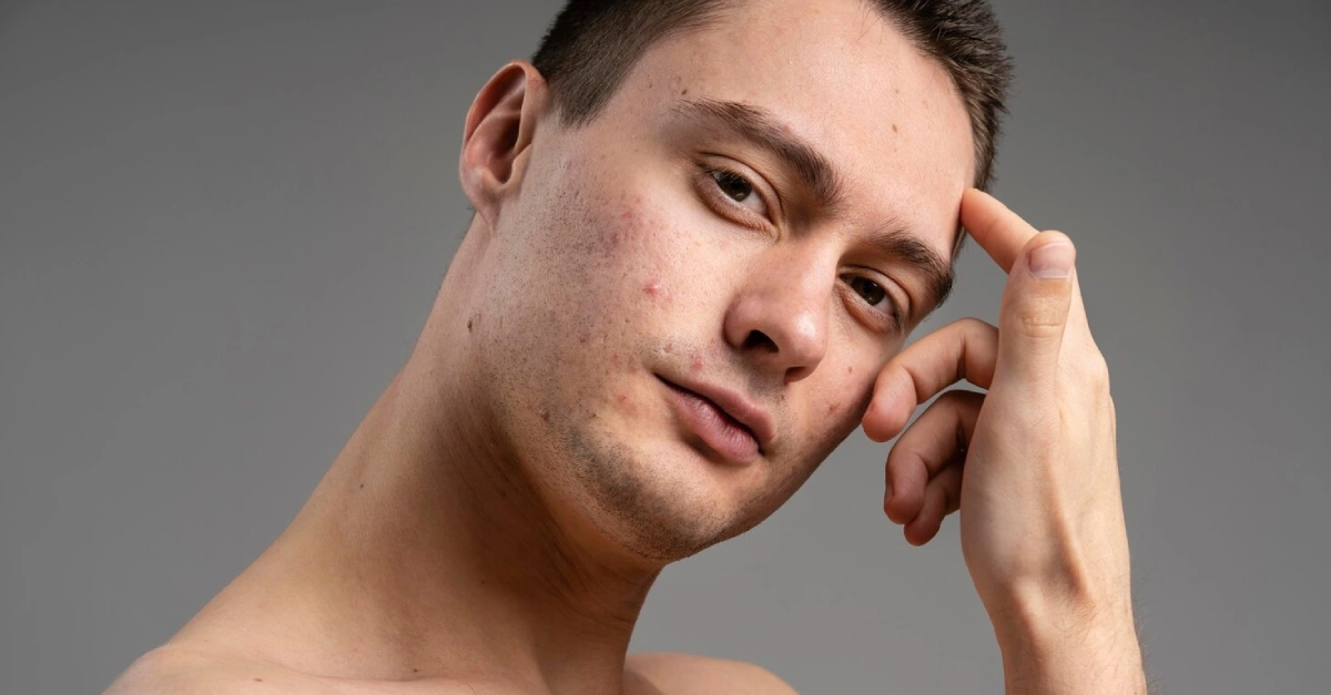 Top Dermatologist-Recommended Treatments for Acne Scars