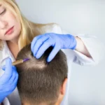 Hair Transplant Vs P-RP Hair Therapy
