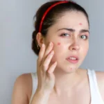 How Stress Can Trigger Acne and What You Can Do About It?