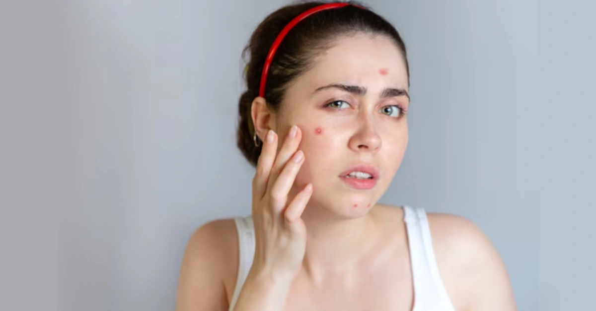 How Stress Can Trigger Acne and What You Can Do About It?