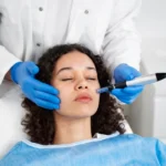 Microneedling Vs Chemical Peels: Which Is Better for Your Skin?