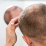 Early Signs of Baldness and When to See a Dermatologist