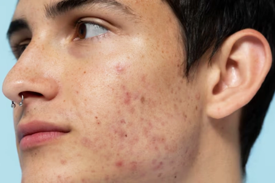 Post-Acne Marks Vs Acne Scars: How to Treat Each Effectively