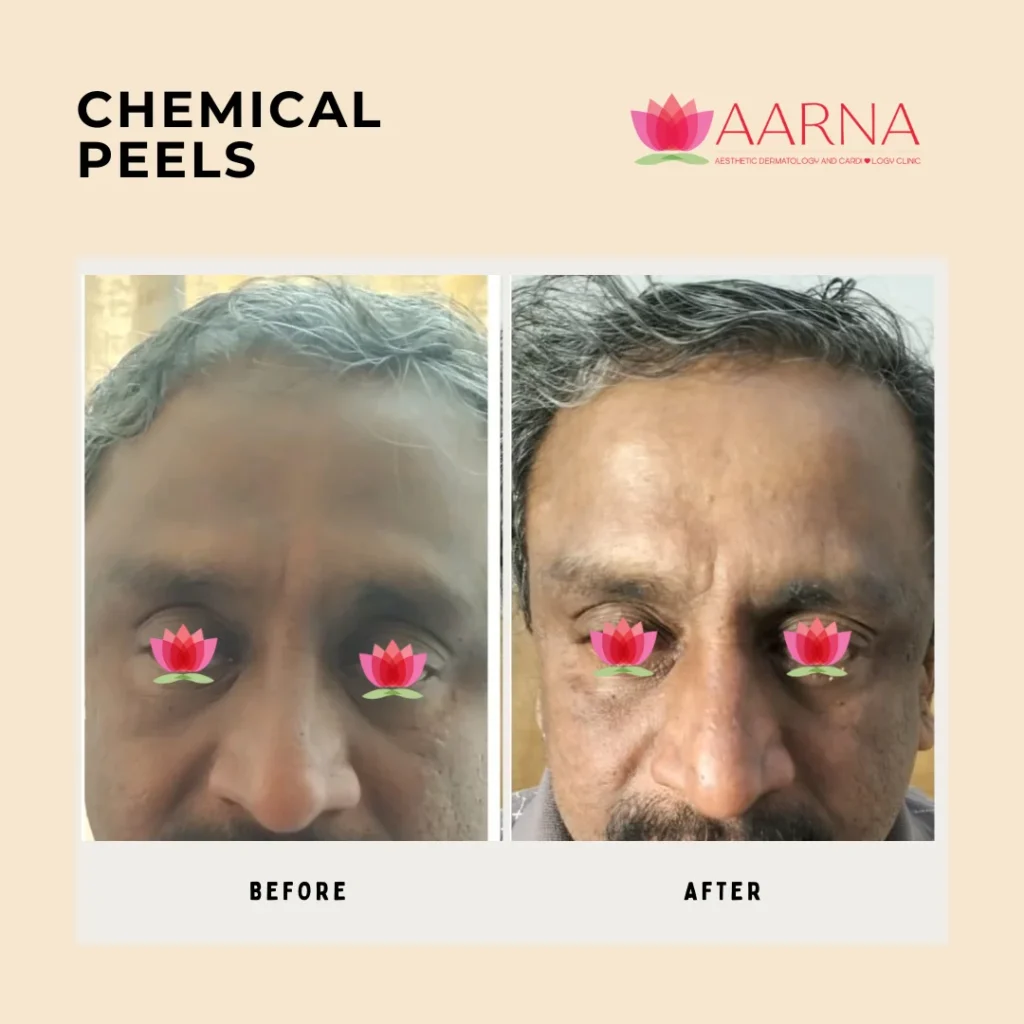 Chemical Peels