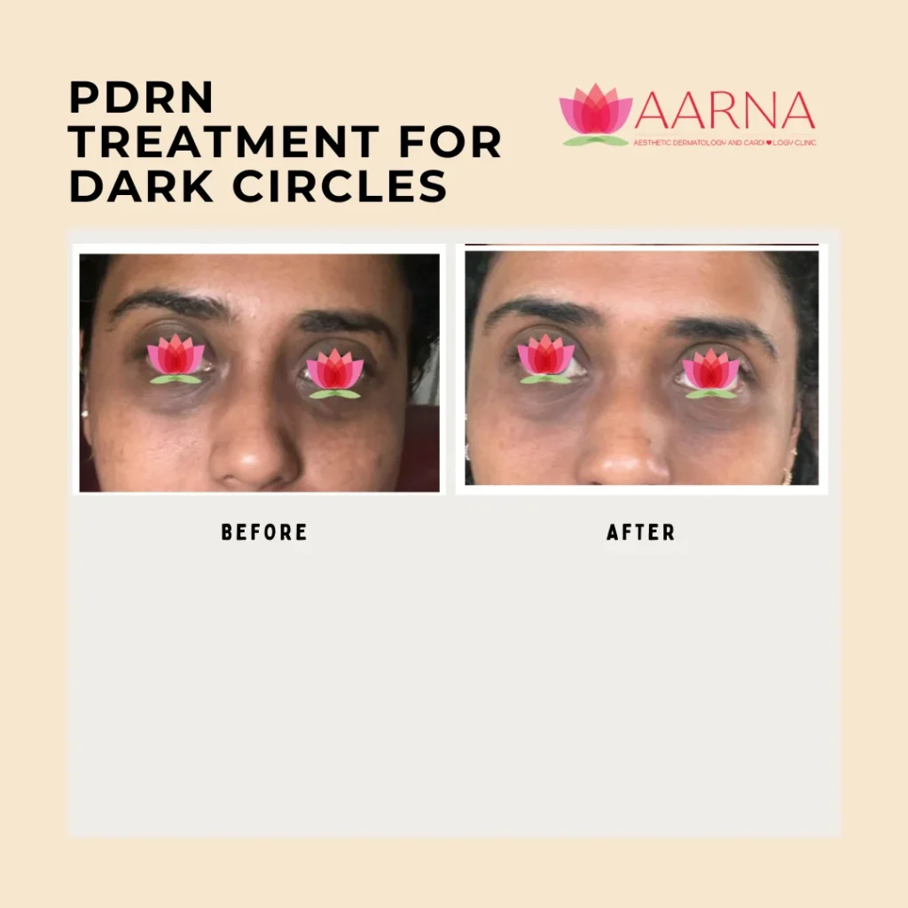 PDRN Treatment for Dark Circles
