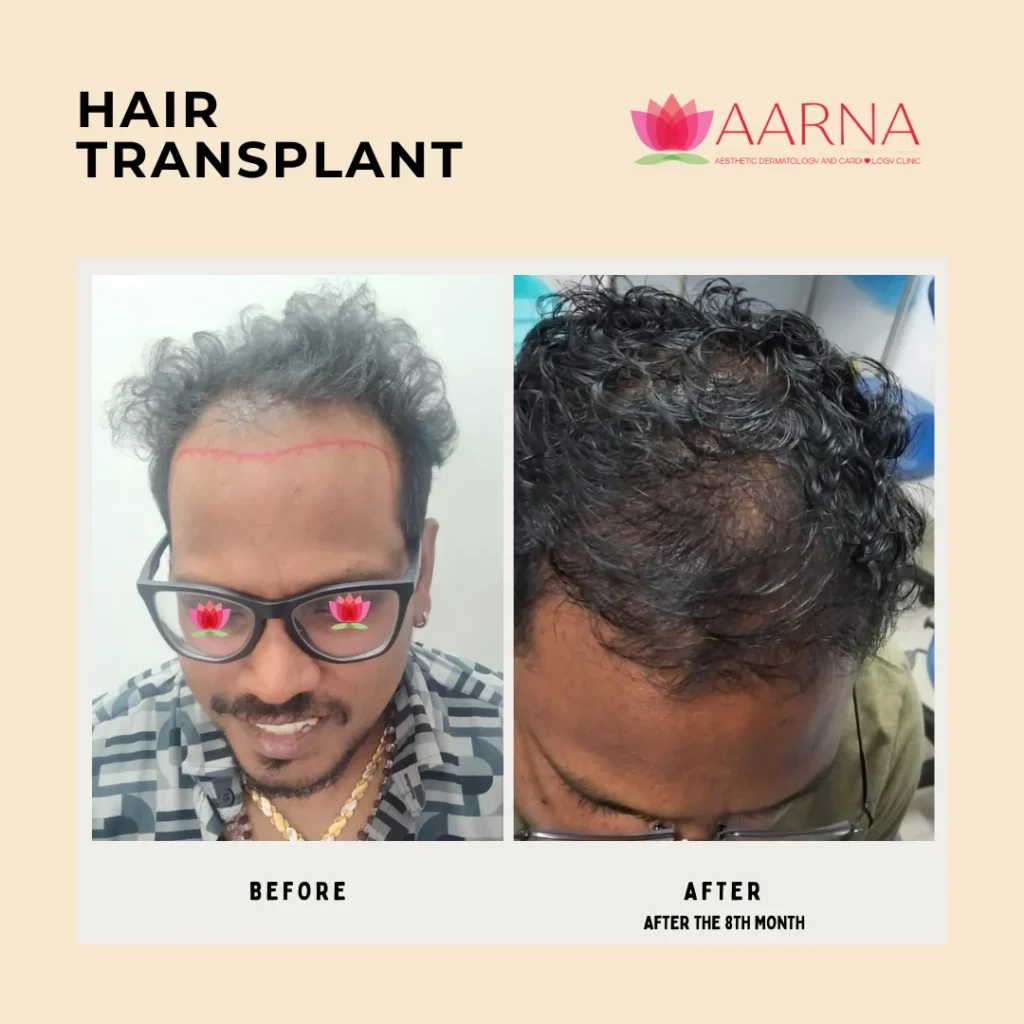 Hair Transplant