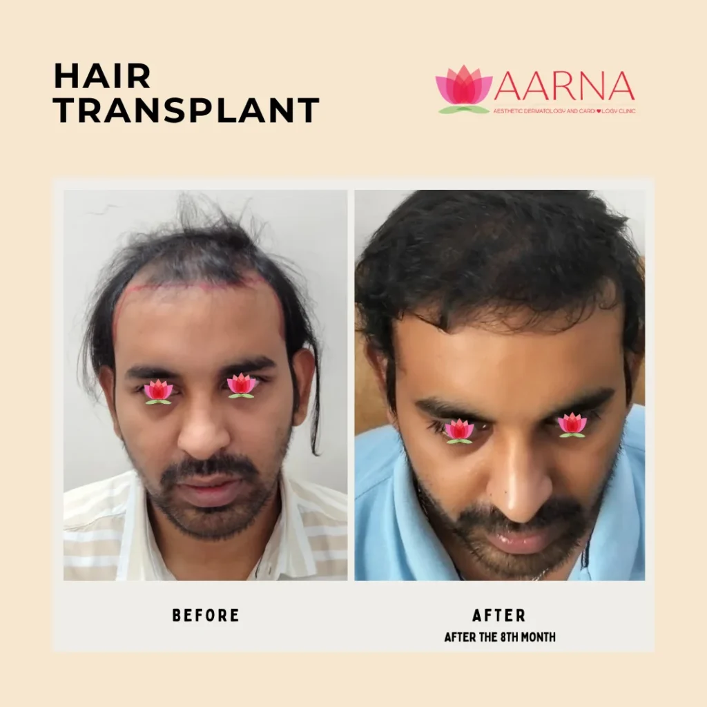 Hair Transplant