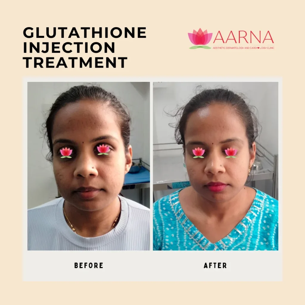Glutathione Injection Treatment
