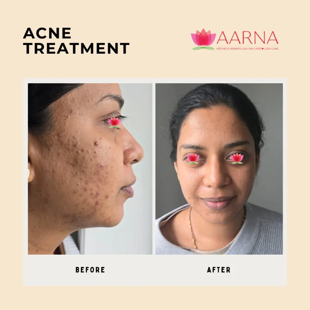 Acne Treatment