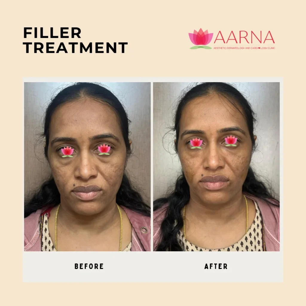 Filler Treatment