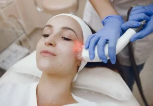 RF Microneedling